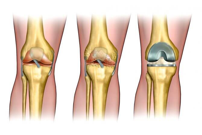 החלפה חלקית או מלאה של מפרק הברך